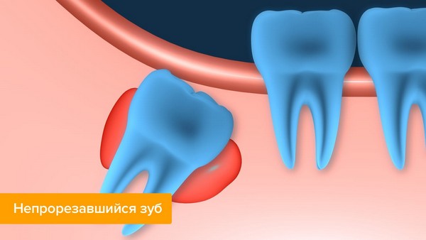 Что такое зуб мудрости? Симптомы зуба мудрости | Ускюдарская стоматология
