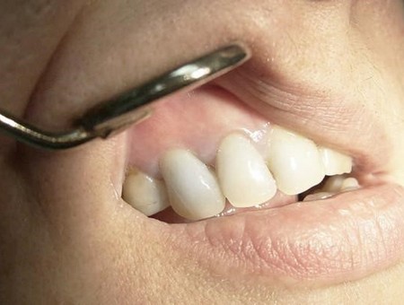 Киста и гранулема зуба - как вылечить?