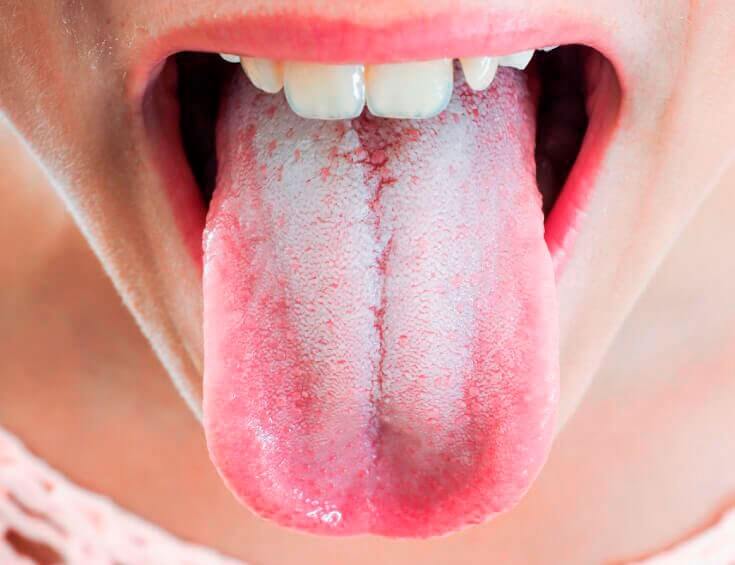 Причины кандидоза полости рта