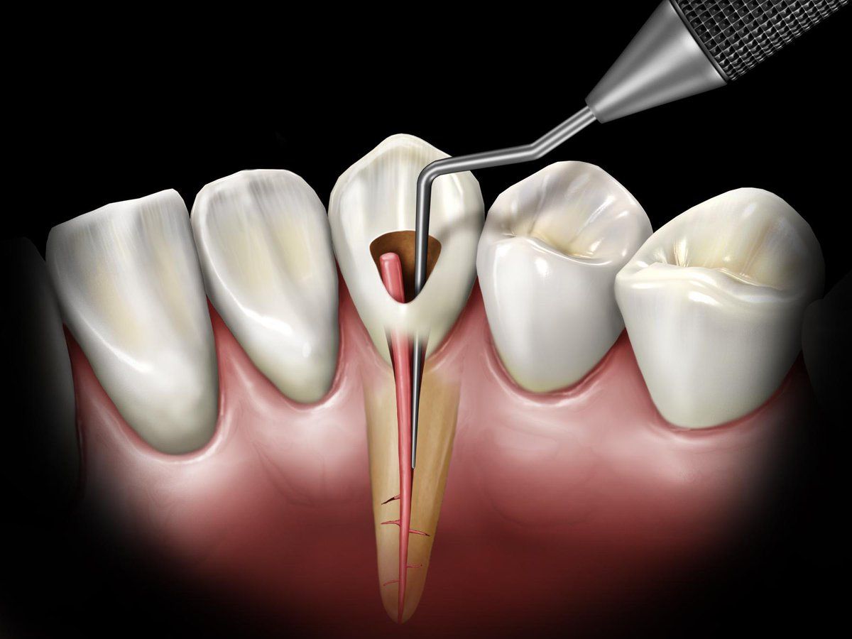 Что нужно знать об удалении нерва зуба